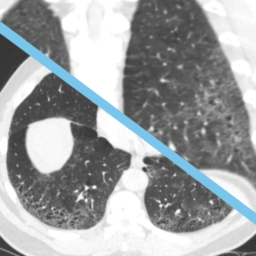 ILD on CT